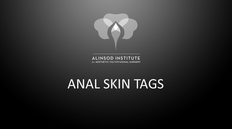 anal skin tags